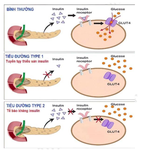 Hình bên mô tả về sự điều hòa lượng đường trong máu của hoocmôn insulin, kết luận nào sau đây sai?  A. Insulin làm giảm đường huyết bằng cách kích thích tế bào đích tăng cường vận chuyển glucose từ máu vào tế bào. (ảnh 1)